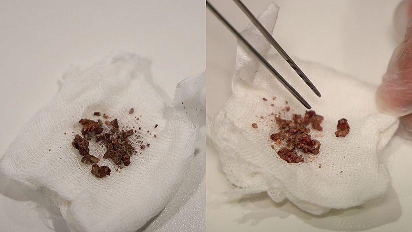 Elazığ'da doktorları bile şaşırtan vaka: Burun içinden taş çıkarıldı