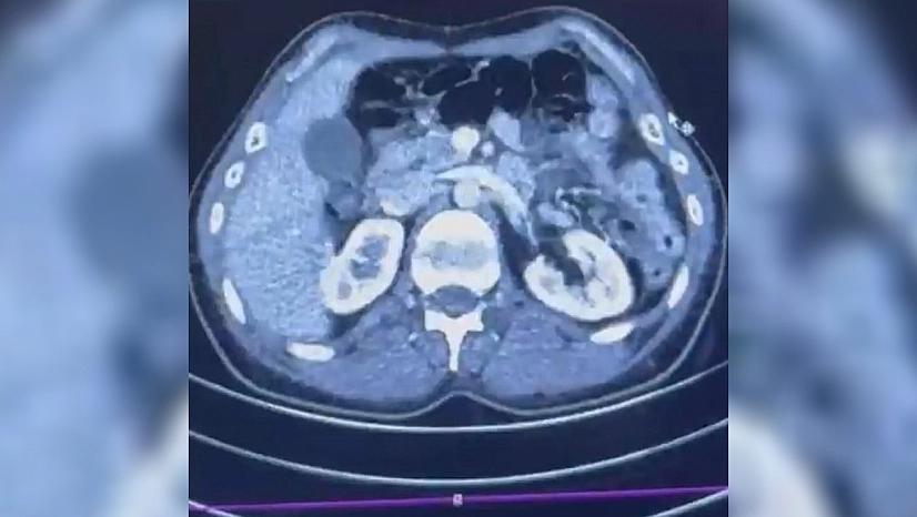 Midelerinde uyuşturucu taşıyan şüpheliler yakalandı