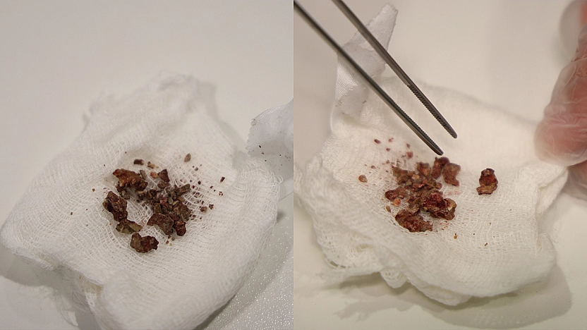 Elazığ'da doktorları bile şaşırtan vaka: Burun içinden taş çıkarıldı