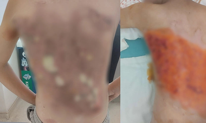 12 yaşındaki çocuğun sırtına kolonya döküp yaktılar