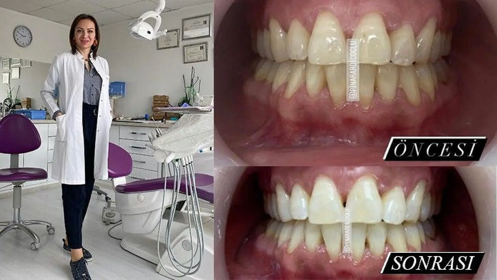 Diş Beyazlatma Tedavisi
