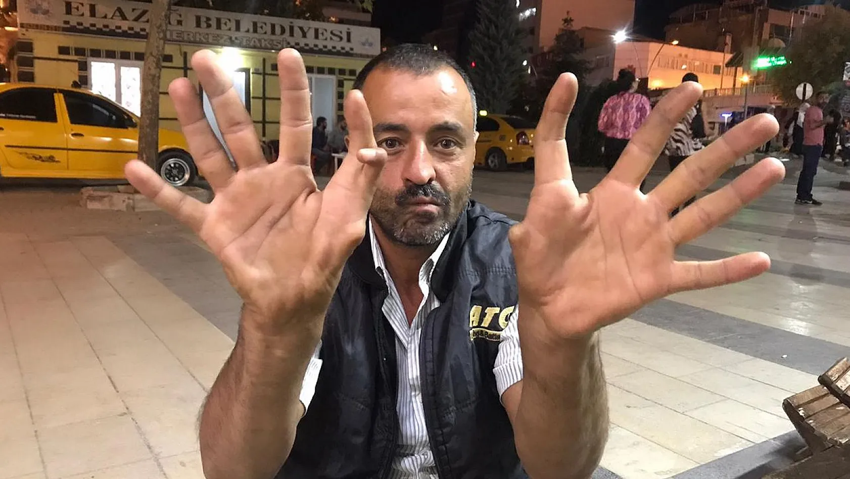 Elazığ'da 6 parmaklı kişi görenleri hayrete düşürüyor