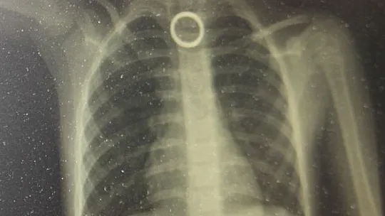 Oyun oynarken yerdeki yüzüğü yutan 3 yaşındaki çocuk ölümden döndü