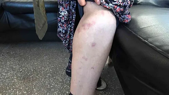 Lazer kadının vücudunu yakmıştı, başka bir güzellik uzmanı tedavisini üstlendi